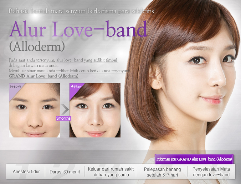 Alur Love-band (Alloderm)